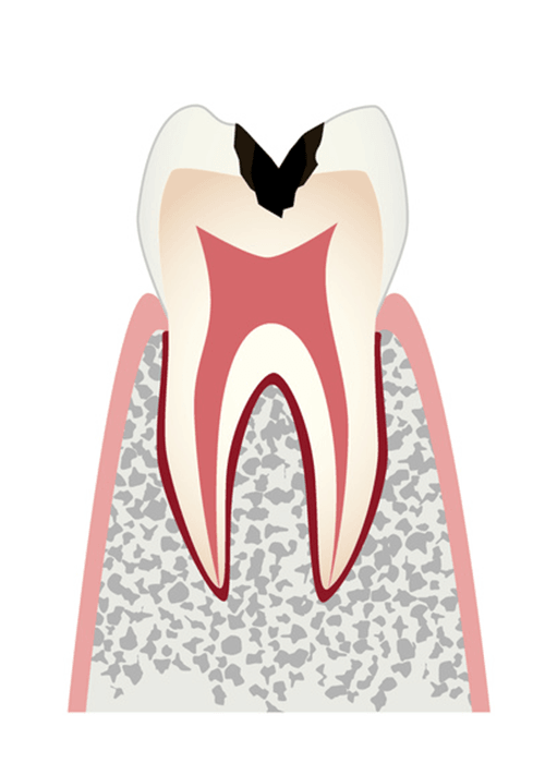 歯の内部に進行したむし歯
