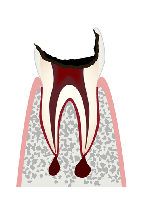 歯の根まで進行したむし歯